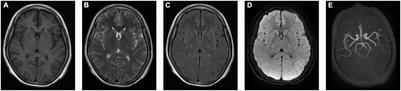 Case Report: Recurrent Hemiplegic Migraine Attacks Accompanied by Intractable Hypomagnesemia Due to a de novo TRPM7 Gene Variant